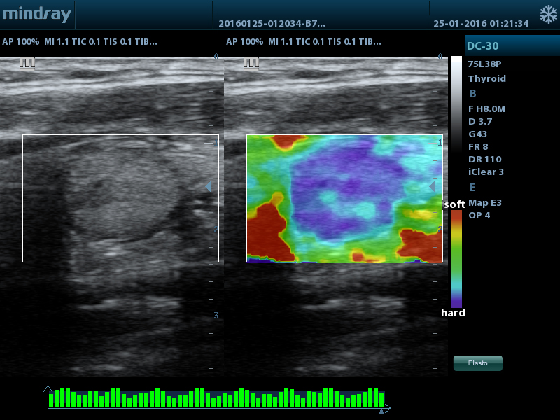 Natural_Touch_Elastography